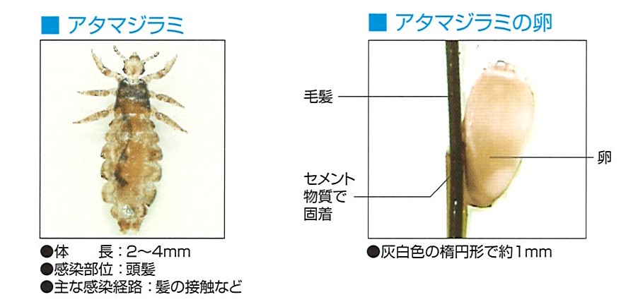 頭ジラミ｜やおさか皮フ科クリニック 本郷三丁目 皮膚科 小児皮膚科 アレルギー 文京区