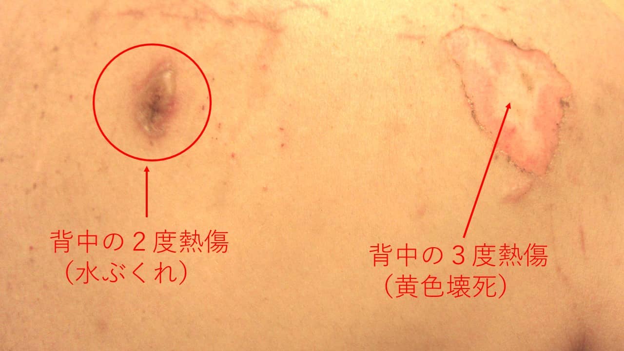 やけど やおさか皮フ科クリニック 本郷三丁目 皮膚科 小児皮膚科 アレルギー 文京区